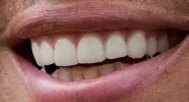 Picture of Alex Rodriguez teeth and smile