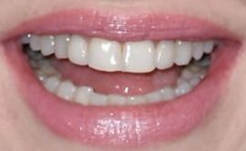 Picture of Amanda Seyfried teeth and smile