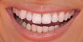 Picture of Amber Lancaster teeth and smile