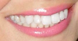 Picture of Amber Lancaster teeth and smile