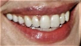 Picture of Anne Hathaway teeth and smile