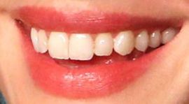 Picture of Anne Hathaway teeth and smile