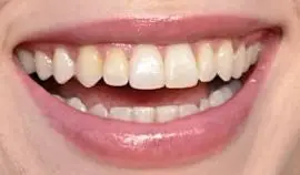 Billie Eilish's teeth and smile
