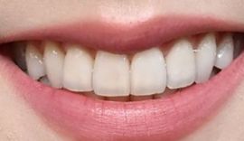 Picture of Blackpink Jisoo's healthy teeth and smile