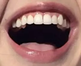 Picture of Blackpink Lisa's perfect teeth and smile