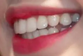 Picture of Blackpink Lisa's perfect teeth and smile