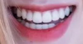 Picture of Blackpink Rosé's healthy teeth and smile