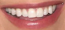Blake Lively's teeth and smile