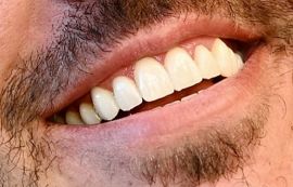 Picture of Brooks Koepka teeth and smile