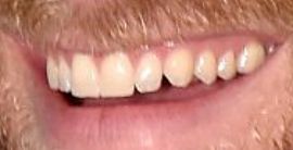 Picture of Chase Rice teeth and smile