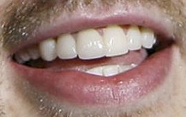 Picture of Chris Evans teeth and smile