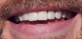 Picture of Chris Evans teeth and smile