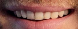 Chris Hemsworth teeth