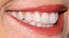 Picture of Christie Brinkley teeth and smile