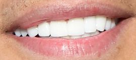 Picture of Dale Moss teeth and smile