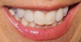 Picture of Denise Austin teeth and smile