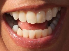 Picture of Denise Austin teeth and smile