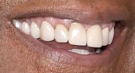Picture of Denzel Washington teeth and smile