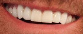 Picture of Dustin Johnson teeth and smile