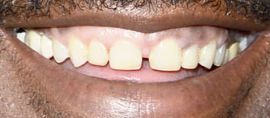 Picture of Eddie Murphy teeth and smile