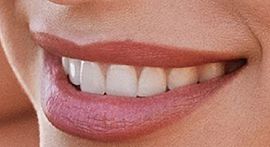 Picture of Hailey Baldwin-Bieber teeth and smile