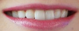 Picture of Holly Madison teeth and smile