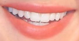 Picture of Isabel May teeth and smile