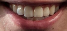 Picture of Jacob Sartorius teeth and smile