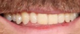 Picture of Jake Gyllenhaal teeth and smile