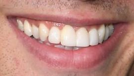 Picture of Jamie Campbell Bower teeth and smile