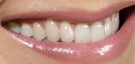 Jennifer Aniston's teeth