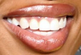 Picture of Jennifer Hudson's teeth and smile while smiling