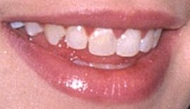 Picture of Jennifer Love Hewitt teeth and smile