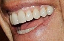 Picture of Jerry Seinfeld teeth and smile