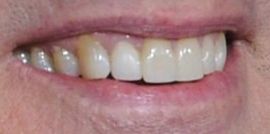 Picture of Jim Carrey teeth and smile