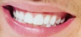 Justin Bieber's teeth