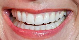 Picture of Kate Middleton teeth and smile