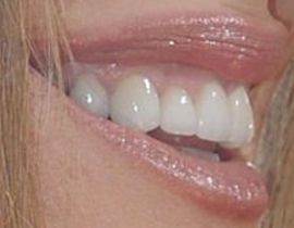 Picture of Kathy Ireland teeth and smile