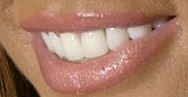 Picture of Katie Price teeth and smile