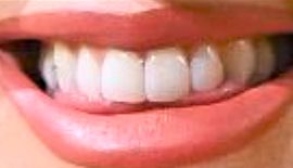 image of Katy Perry's teeth