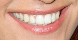 Picture of Kelly Brook teeth and smile