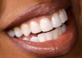 Kelly Rowland's teeth