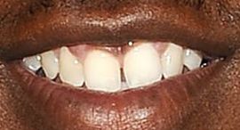 Picture of Kendrick Lamar teeth and smile