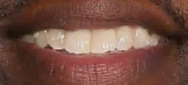 Picture of Kevin Hart teeth and smile