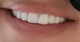 Khloe Kardashian's teeth
