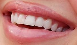 Picture of Kylie Jenner teeth and smile