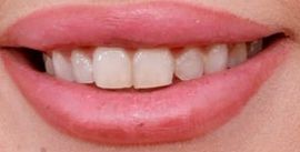 Lady Gaga's teeth