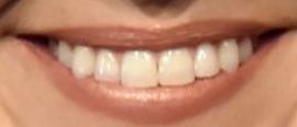 Picture of Lainey Wilson's healthy teeth and winning smile