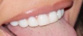 Picture of Latto teeth and smile