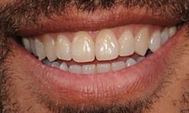 Picture of Lenny Kravitz teeth and smile